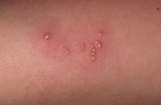 what-are-the-first-symptoms-of-the-first-herpes-outbreak