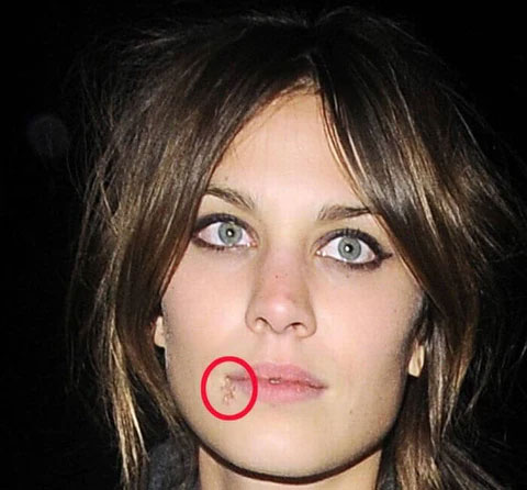 Alexa Chung with herpes, celebrities with cold sores pictures