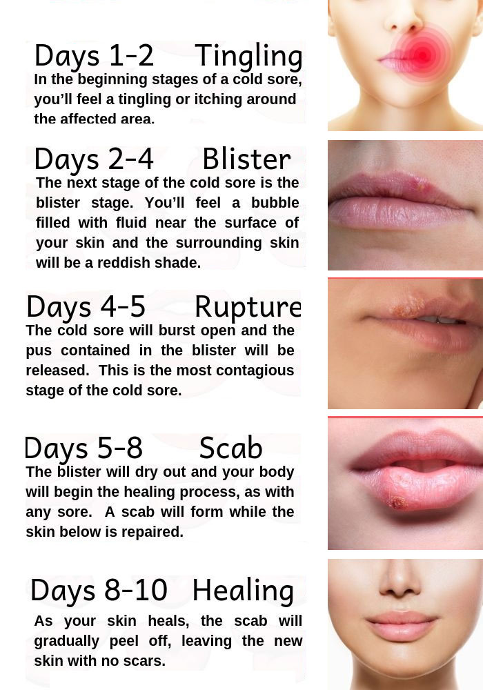 Herpes photos in different stages