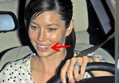 Jessica Biel, celebrities with cold sores pictures