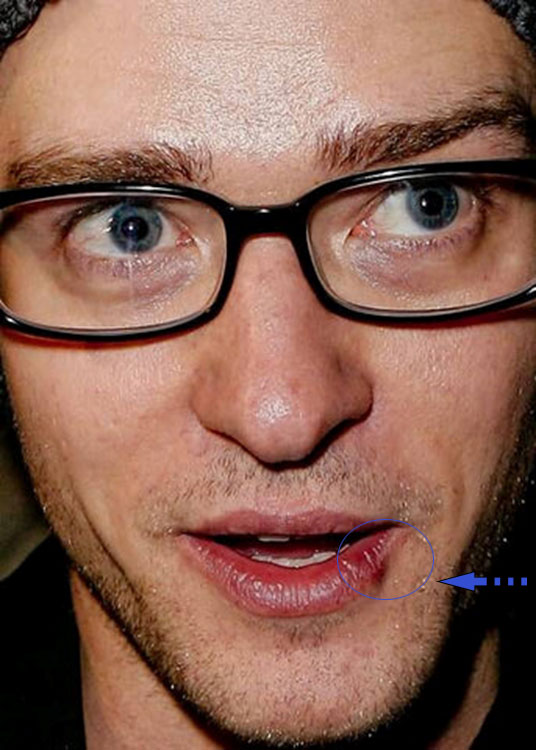 Justin Timberlake with cold sore, celebrities with cold sores pictures