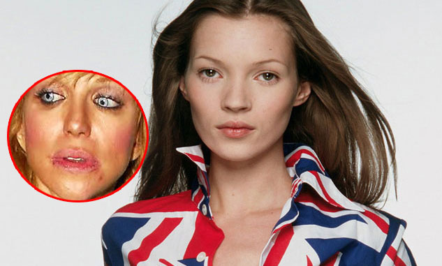 Kate Moss have herpes
