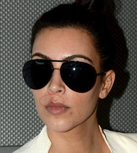 Kim Kardashian with cold sore, celebrities with cold sores pictures 