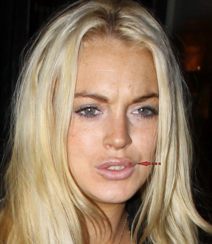 Lindsay Lohan with cold sore, celebrities with cold sores pictures