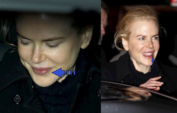 Nicole Kidman with hepres, celebrities with cold sores pictures