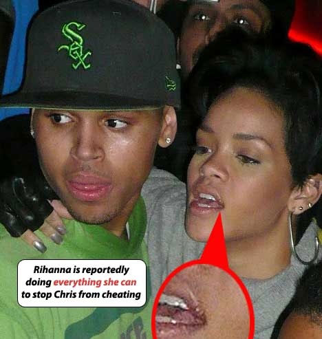 Rihanna with cold sore, celebrities with cold sores