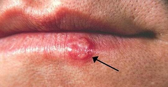 Herpes symptoms pictures, hsv1, Herpes Simplex Virus Type 1, cold sore, What does a herpe sore look like
