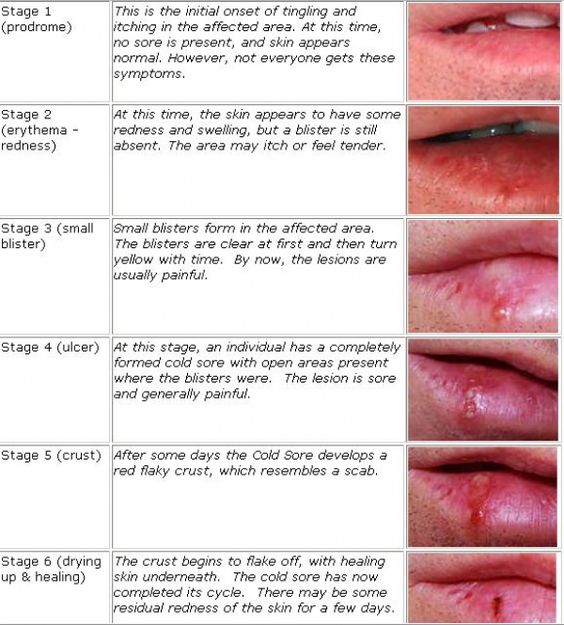 Stages Of Cold Sores