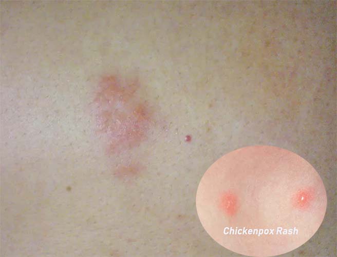 early stage herpes symptoms pictures in men,What does a herpe sore look in early stage
