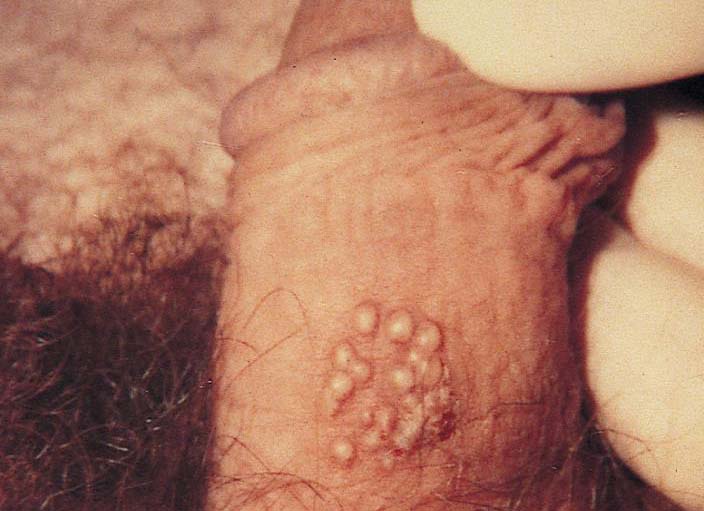 genital herpes symptoms pictures in men,What does a herpe sore look like in men