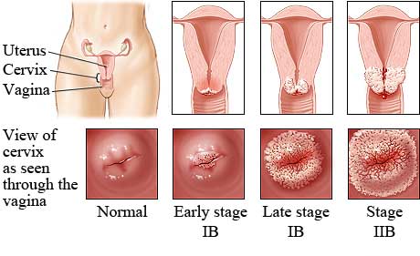 Genital Herpes Symptoms in Women, What does a herpe sore look like