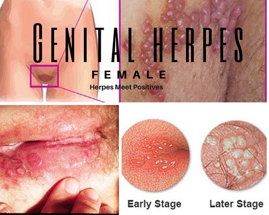 Genital Symptoms in Women, What does a herpe sore look like