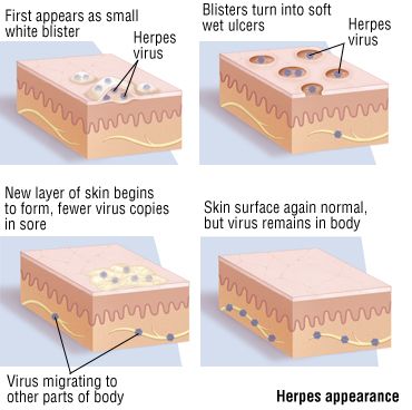 herpes fast facts