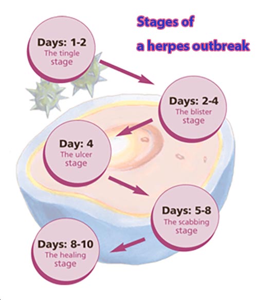 herpes outbreak stages, stages of a herpes outbreak