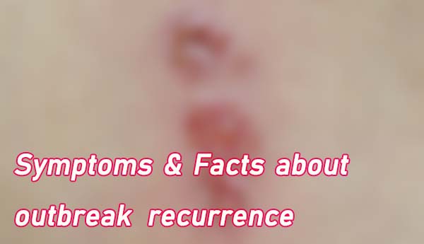 symptoms, herpes recurrence, repeat outbreak