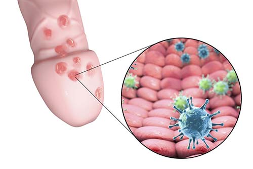 genital herpes, HSV2, HSV-2,What does herpes look like