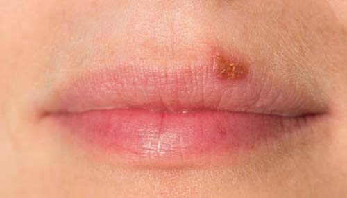 oral herpes, HSV1, HSV-1,What does herpes look like
