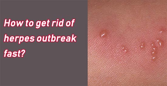 How to get rid of herpes outbreak fast?