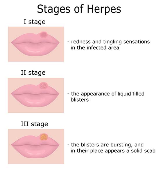 stages of a herpes outbreak
