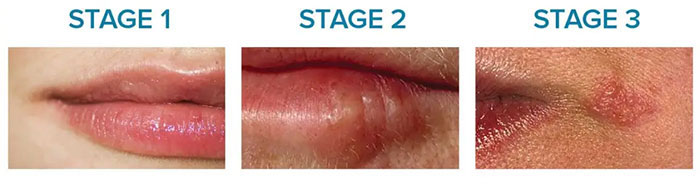 What does a herpe sore look like in different stages